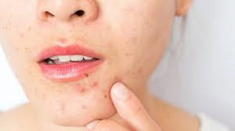 how to treat pimples
